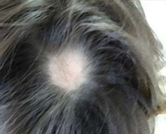 alopecia-areata-001